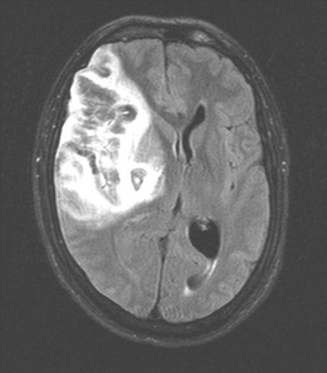 Magneettiresonanssikuvassa aivot, josta on havavissa oikeanpuoleinen aivoinfrakti